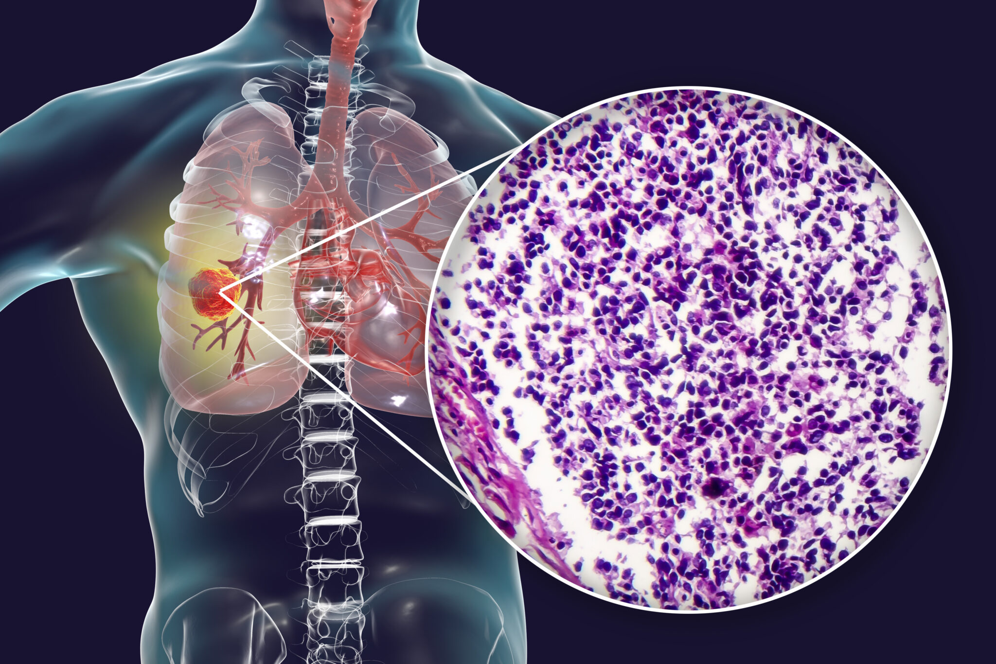 paraneoplastic presentation of small cell lung cancer