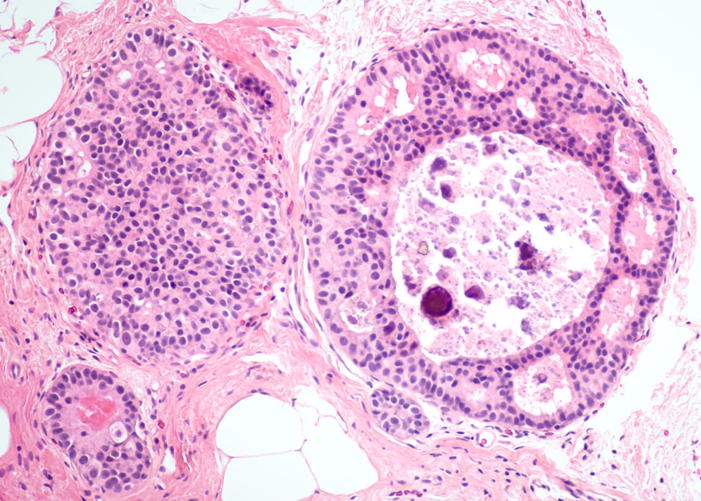 Breast cancer core biopsy - ductal carcinoma in situ (DCIS) detected by screening mammography