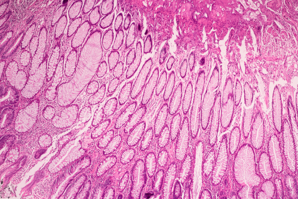 Microscopic ductal cell carcinoma. Adenonocarcinoma from human breast cancer tissue. Magnification 400X