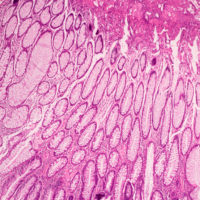 Microscopic ductal cell carcinoma. Adenonocarcinoma from human breast cancer tissue. Magnification 400X