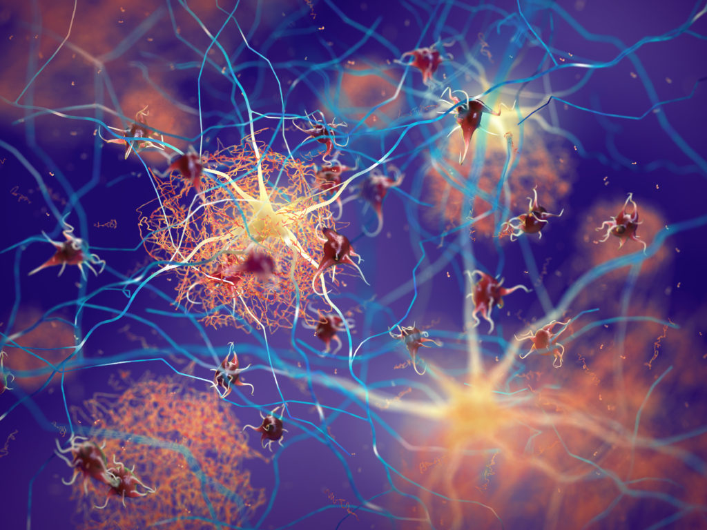 Amyloid plaques forming between neurons. Beta-amyloid protein disrupting nerve cells function in a brain with Alzheimer's disease