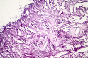 Melanoma, a cancer developing from pigment-containing cells melanocytes, light micrograph, photo under microscope