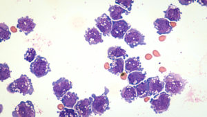 Malignant effusion cytology: microscopic image of diffuse large B-cell lymphoma, a type of non Hodgkin lymphoma.