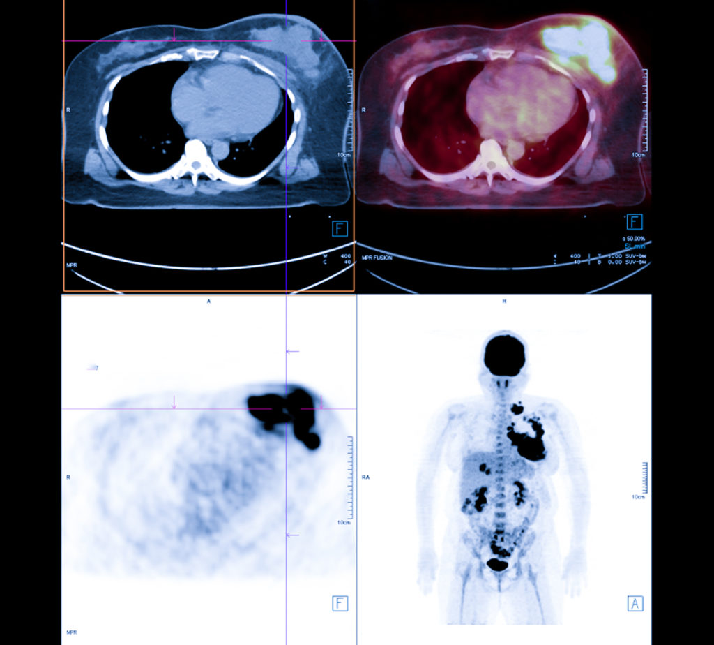 PET Scan image of whole body Comparision Axial , Coronal  plane in patient breast cancer recurrence treatment.