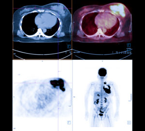 PET Scan image of whole body Comparision Axial , Coronal plane in patient breast cancer recurrence treatment.