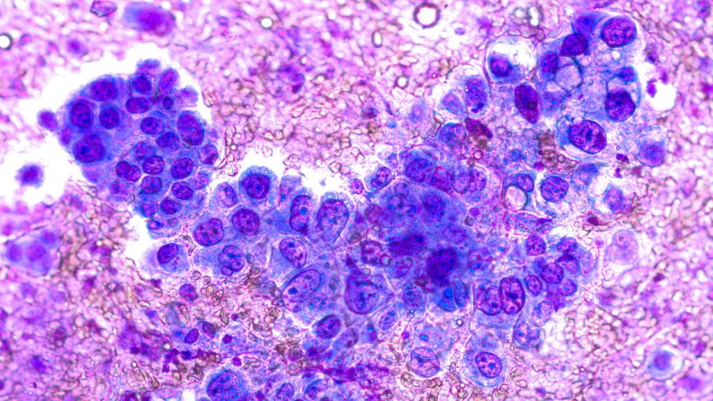 Photomicrograph of fine needle aspiration (FNA) cytology of a pulmonary (lung) nodule showing adenocarcinoma, a type of non small cell carcinoma.