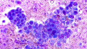 Photomicrograph of fine needle aspiration (FNA) cytology of a pulmonary (lung) nodule showing adenocarcinoma, a type of non small cell carcinoma.