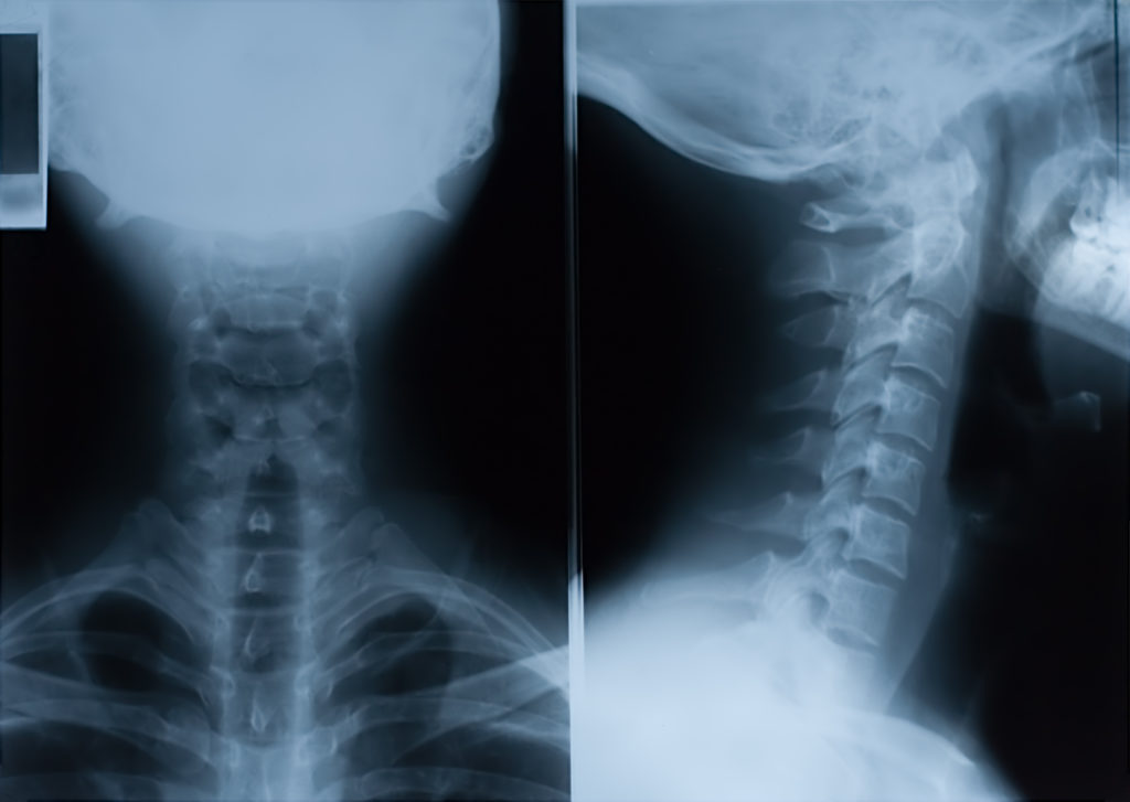 True color X-Ray film of neck - front and side