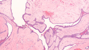Photomicrograph showing histology of a benign phyllodes tumor of the breast, from sections of an excision specimen (lumpectomy).