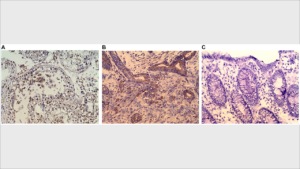 Figure 5: (A) Immunohistochemistry (IHC) staining of testis (positive control). (B) IHC staining of colonic adenocarcinoma. (C) IHC stating of Normal colonic mucosa (negative control). Purified rabbit anti-human CABYR polyclonal antibody for CABYR a/b and c antigen isoforms were used in IHC.