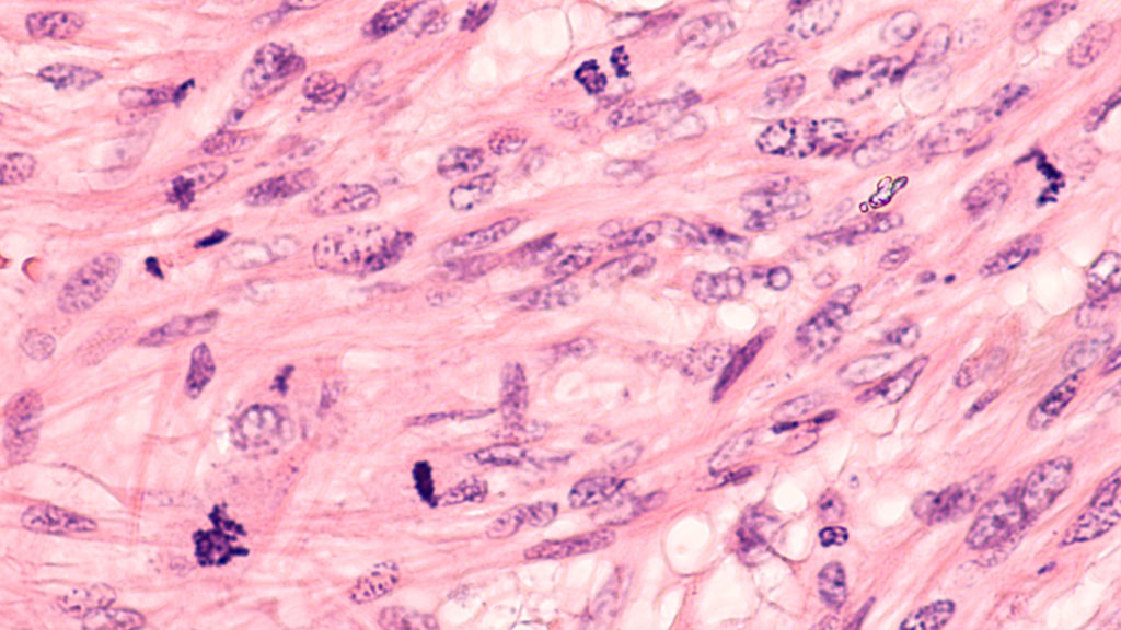 Microscopic image of a leiomyosarcoma, a type of soft tissue sarcoma of smooth muscle. This malignant tumor typically occurs in the uterus or GI tract.