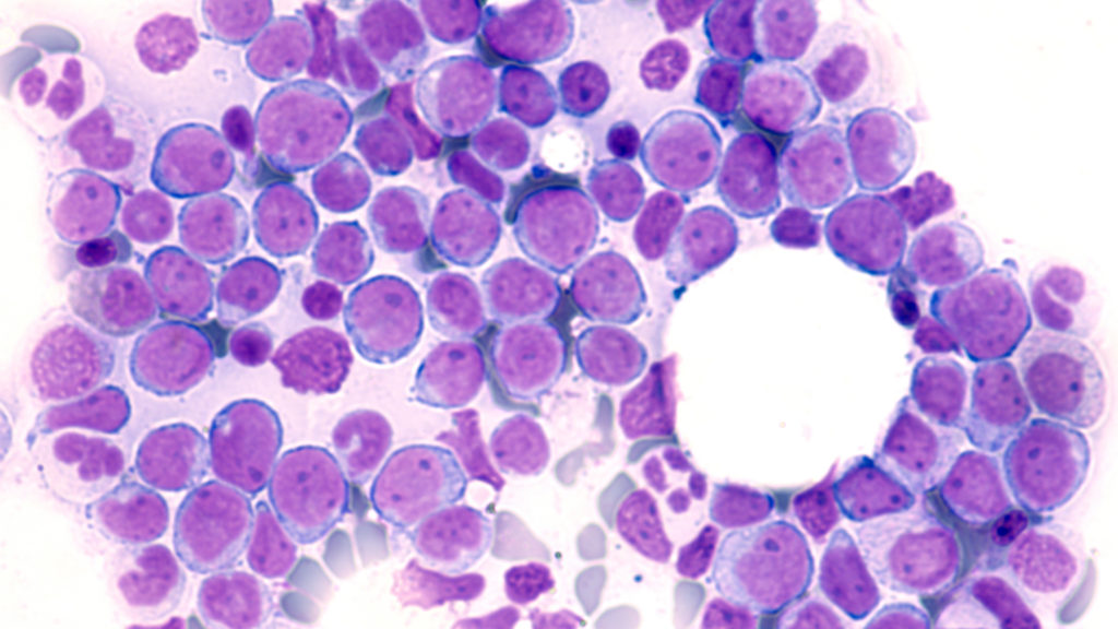 Photomicrograph of bone marrow aspirate showing myeloblasts of acute myeloid leukemia (AML), a cancer of white blood cells.