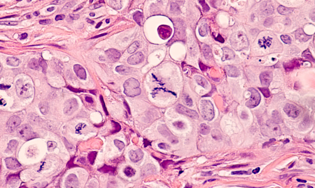 Photomicrograph of a breast cancer (grade 3 invasive ductal carcinoma) with frequent mitoses (mitotic figures), including a large central atypical mitoses.