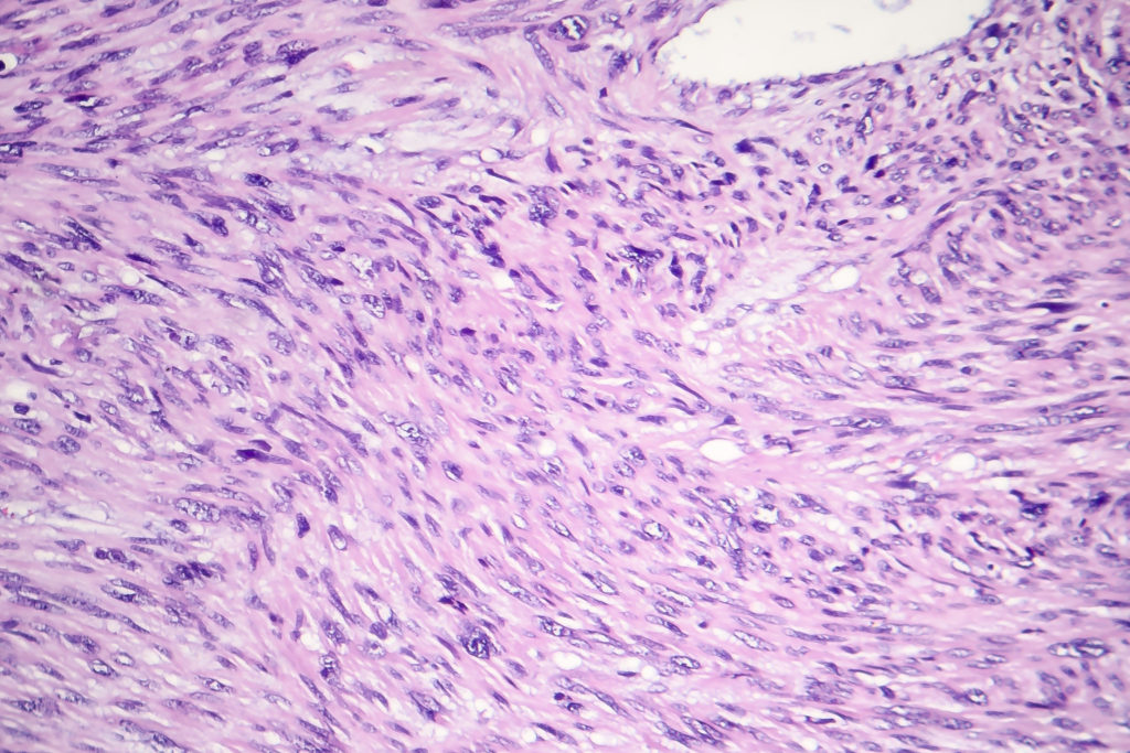 Leiomyosarcoma, a malignant cancerous smooth muscle tumor, light micrograph, photo under microscope