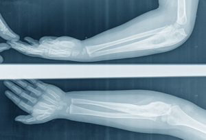A child x-ray elbow ​Lateral, AP view of the forearm caused by bone cancer(osteosarcoma) of the ulna.