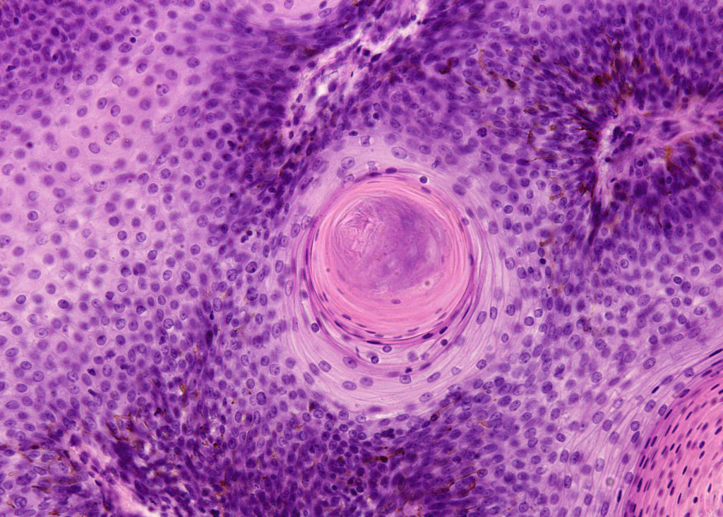 Keratin pearl found in a papilloma of the larynx. It is a keratinized structure found in regions where abnormal squamous cells form concentric layers.
