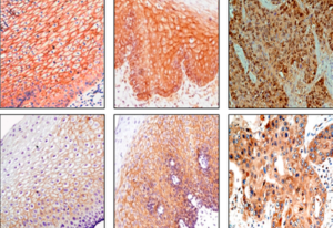 (Rotated) Figure 1: Immunohistochemical analysis of Wnt protein in esophageal tissues.