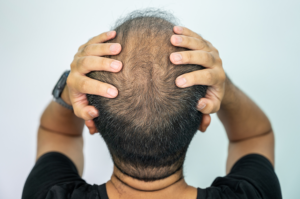 Can Mechanisms of Hair Loss Shed Light on Cancer and Aging?