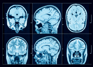 New Drug May Boost Effectiveness of Glioblastoma Treatment